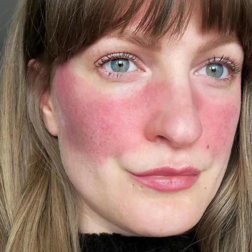 Rosacea/ Facial Flushing One Cosmetic