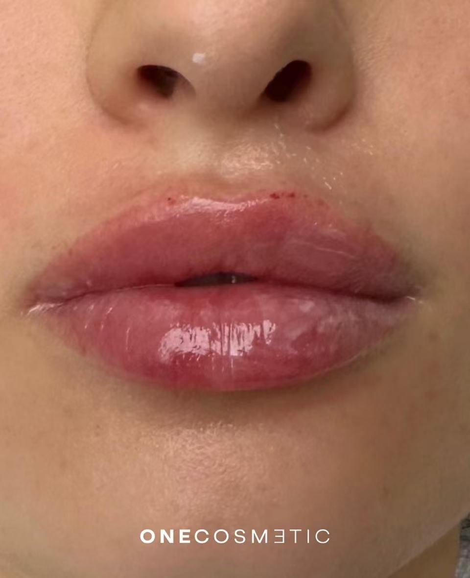 Lip Volumisation
