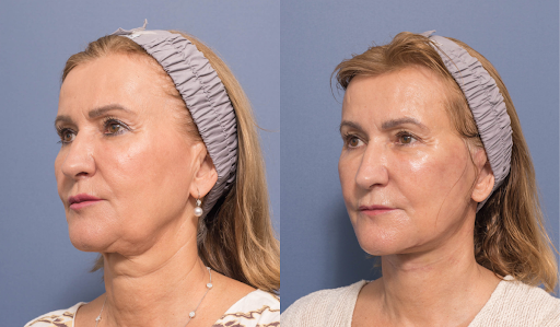 Facelift with Buccal Fat Pad Removal and Profound RF on the Neck - Carolina  Facial Plastics