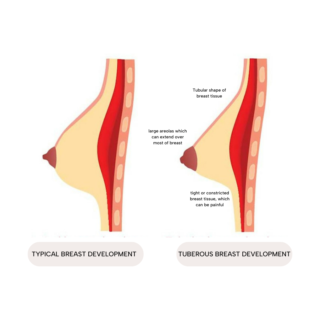 Tuberous Breast